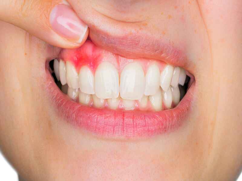 تاثیر آلوئه ورا بر لثه و کاهش التهاب