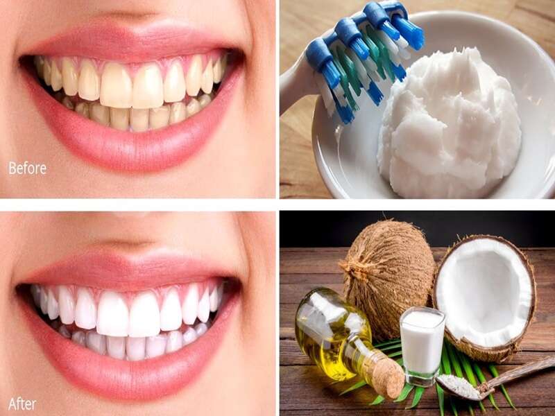 خواص بی‌نظیر روغن نارگیل برای دندان