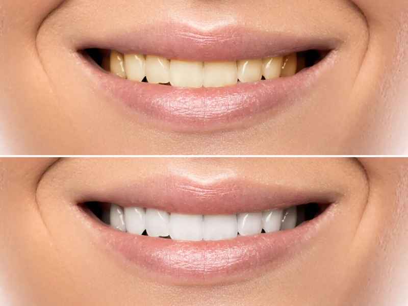 روش‌های موثر برای جلوگیری از زردی و تیرگی دندان‌ها