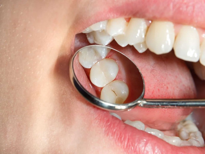 چگونه از پوسیدگی دندان پیشگیری کنیم؟ راهکارهای ساده و مؤثر