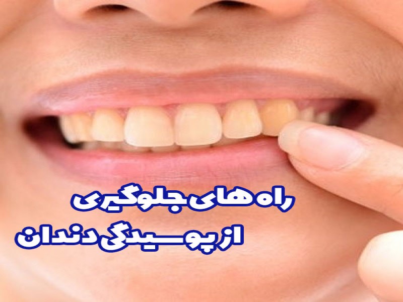 برای جلوگیری از پوسیدگی دندان چه بخوریم ؟